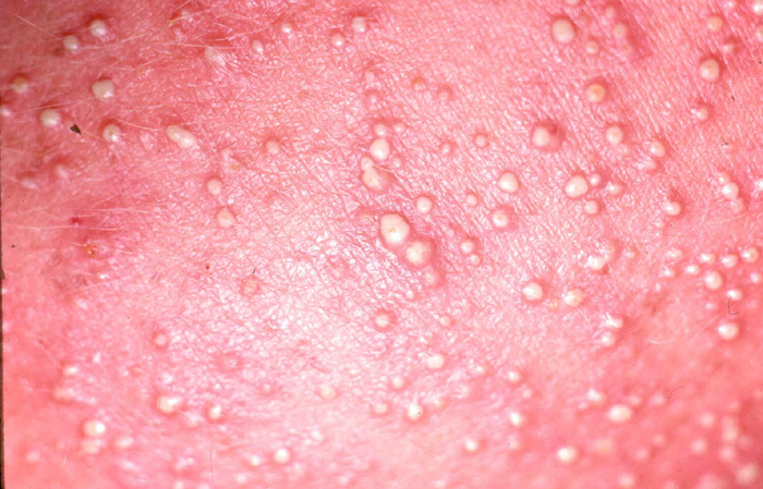 Heat rash macro view. Go to source for larger photo
